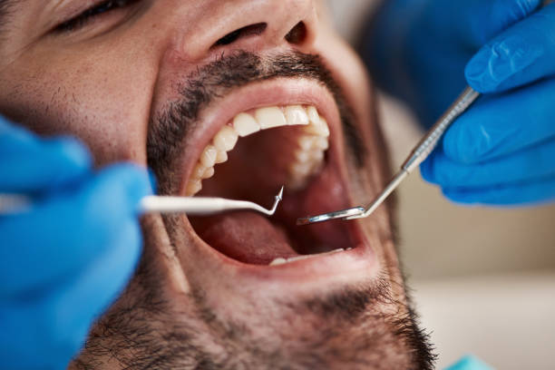 Best Emergency Wisdom Teeth Removal in Cass City, MI